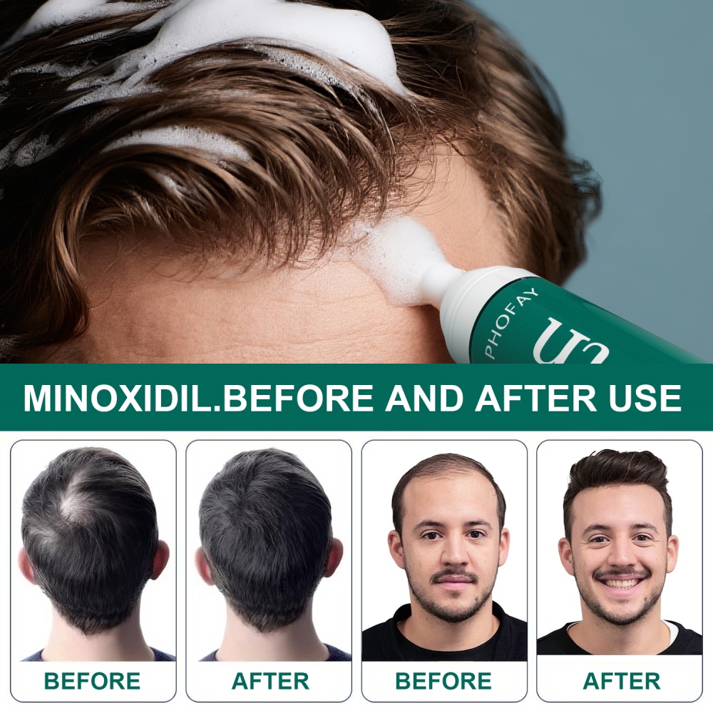 CH004 Minoxidil Anti-Hair Loss Mousse - Revitalize Your Hair Today!