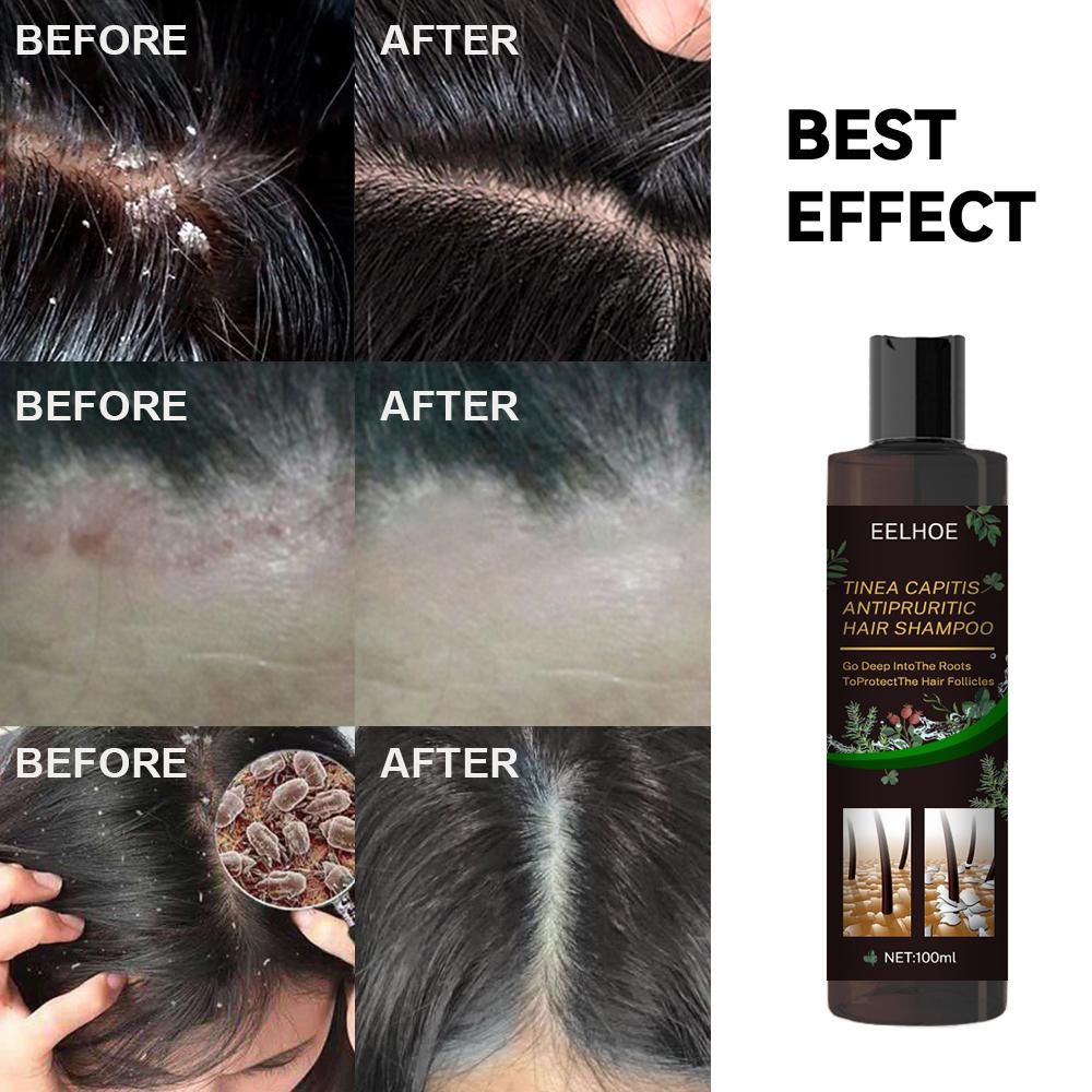 EELHOE Anti-Dandruff Shampoo - Soothing Itch Relief, Hair Loss Prevention, Oil Control & Refreshing Care - Image 4